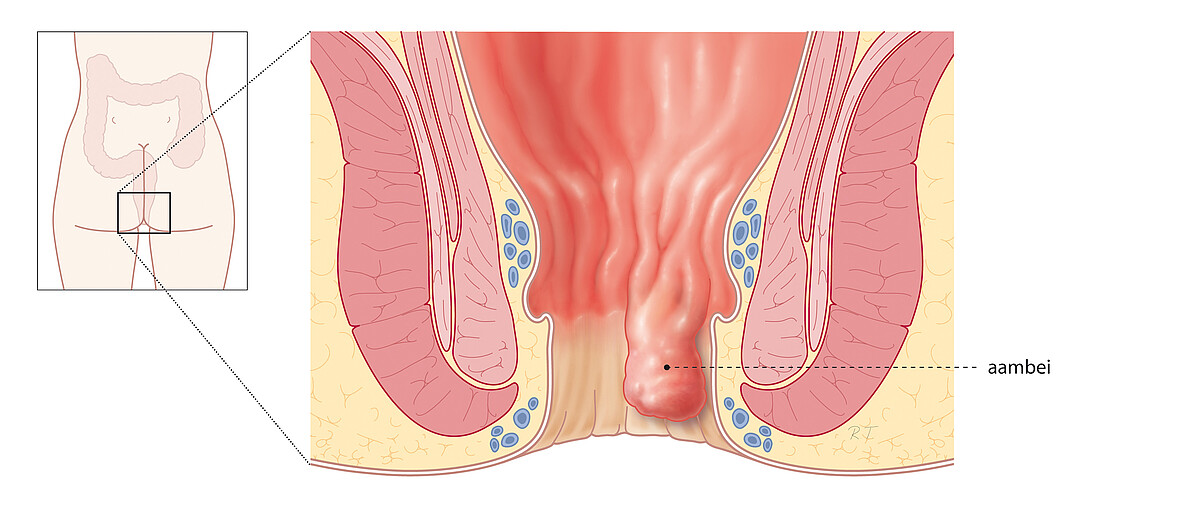 Aambeien Xpert Clinics Proctologie